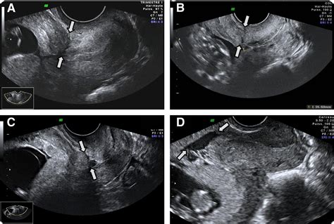 measuring uterine scar thickness on ultrasound|uterine scar thickness first trimester.